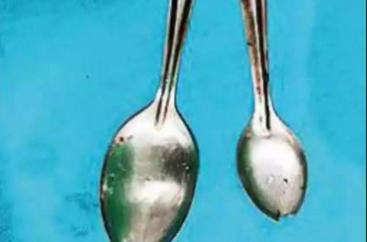 एक व्यक्ति के पेट से डॉक्टरों ने निकला दो स्टील का चम्मच, जानिए कैसे निगला था पूरा चम्मच।